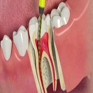 Endodoncia