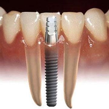 Implantología dental.